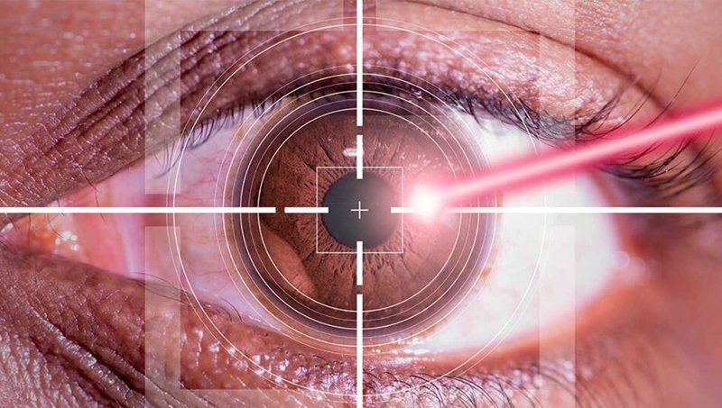 REFRAKTİF GÖZ LASER OPERASYONLARINA HAZIRLIK