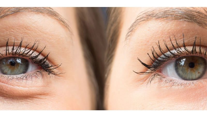 Alt göz kapağı estetiği üst göz kapağı estetiğine göre neden farklıdır?