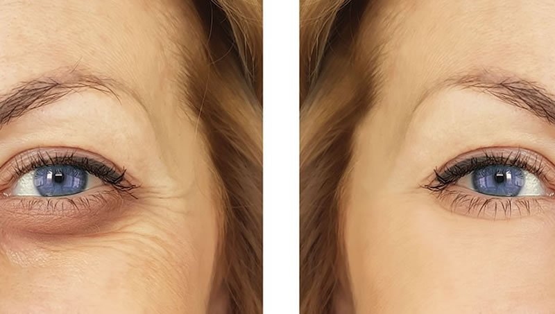 Göz çevremize operasyon dışında nasıl uygulamalar yapabiliyoruz