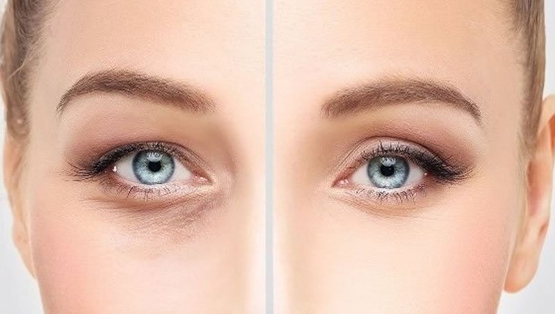 Göz Çevremizin Genç Kalması İçin Bazı İpuçları