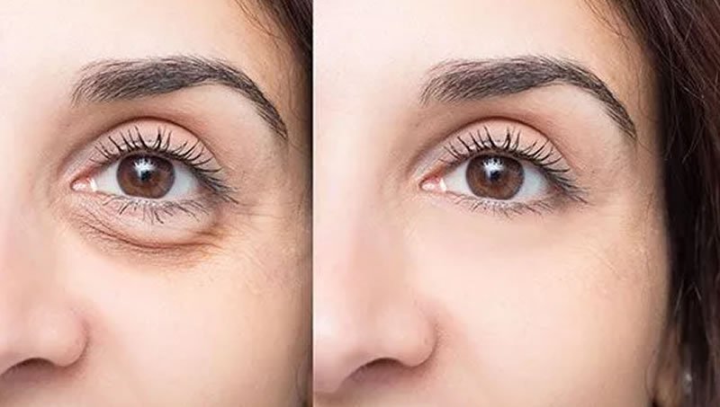 Göz çevresi ameliyatları neden özen ister?