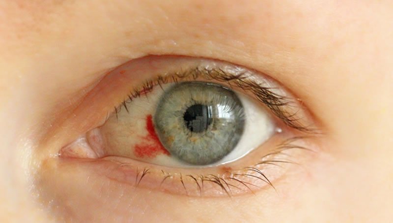 Göz kanlanması neden olur?