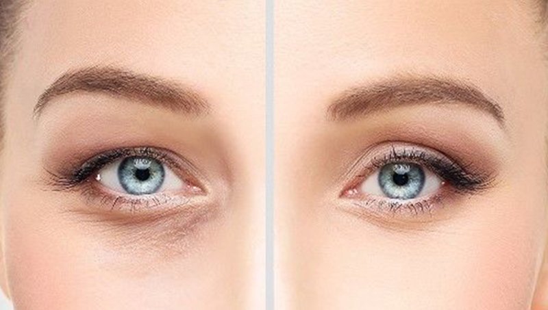 GÖZALTI IŞIK DOLGUSUNUN DİĞER DOLGULARDAN FARKI NEDİR?