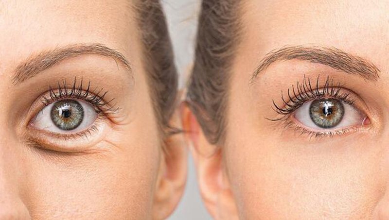 GÖZALTI IŞIK DOLGUSUNUN AMACI VE DİKKAT EDİLMESİ GEREKENLER