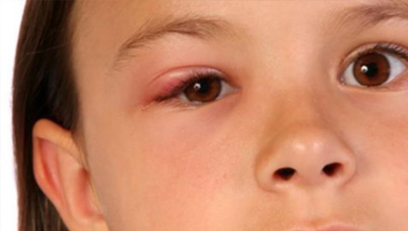 GÖZÜMÜZDE ARPACIK NEDEN OLUŞUR?