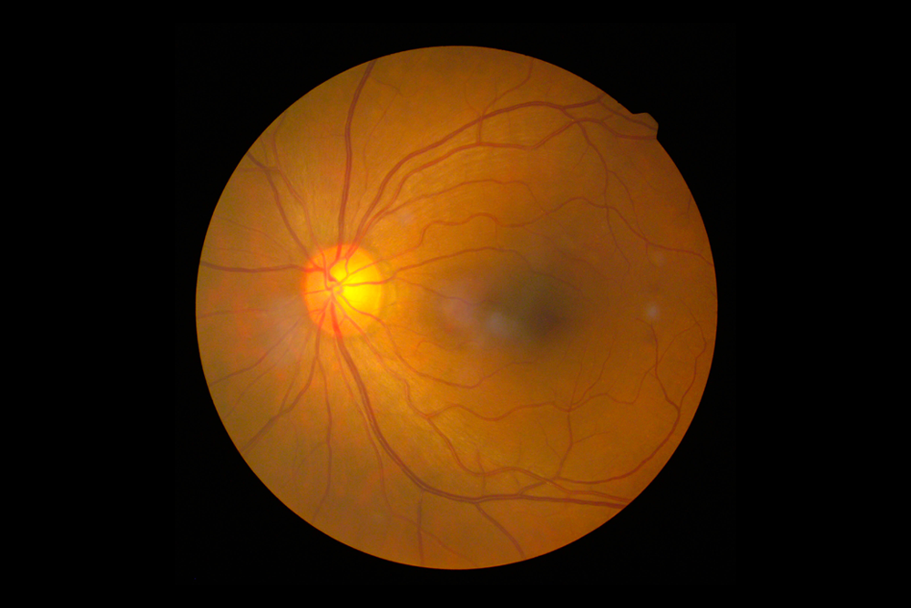 Sarı Nokta Hastalığı (Makula Dejenerasyonu)